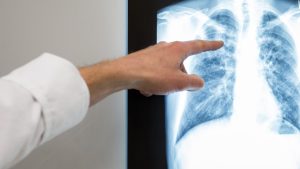 Случаите на туберкулоза в Малайзия надхвърлят 3000, здравното министерство сигнализира за рискове